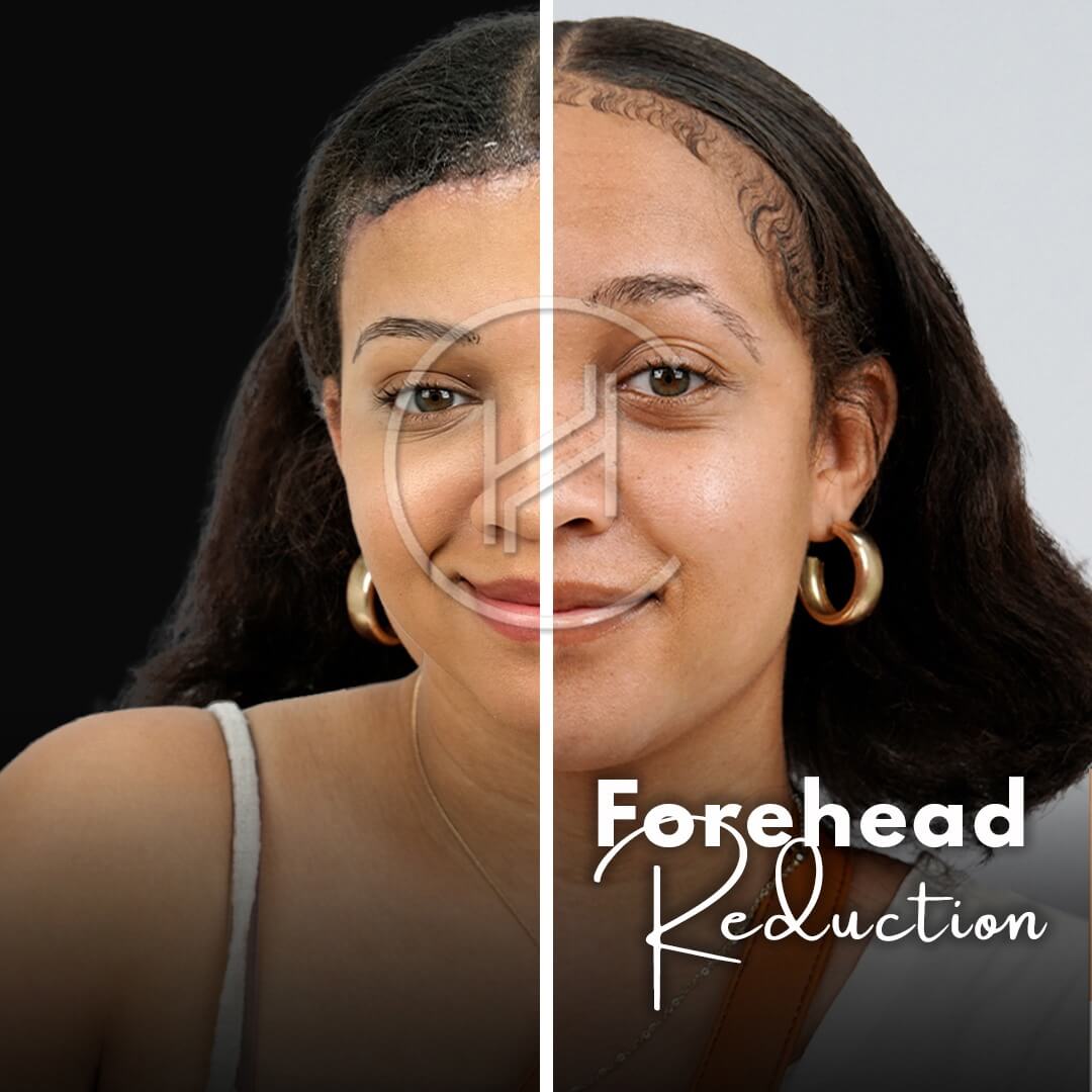 Female Forehead Reduction Before and After Result Female Forehead Reduction Before and After Result