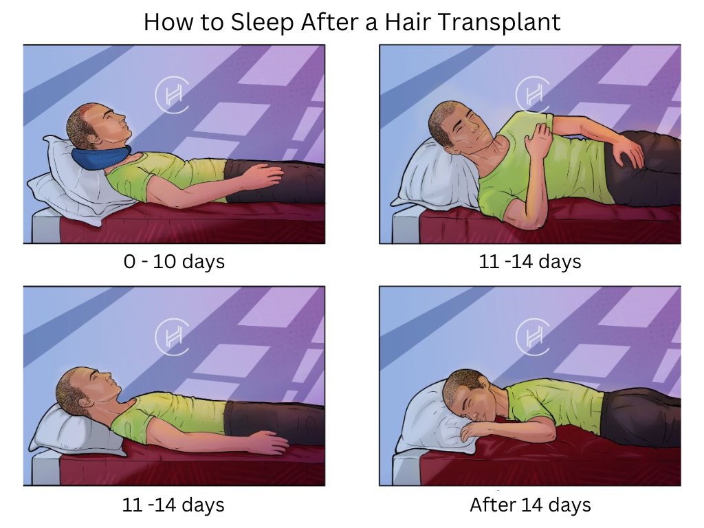 How to Sleep After a Hair Transplant Demonstration