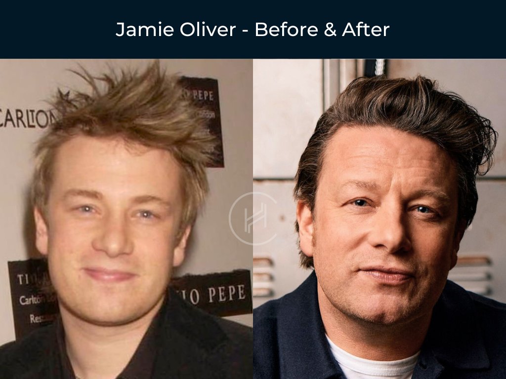Jamie Oliver - Hair Transplant Before and After Jamie Oliver - Hair Transplant Before and After