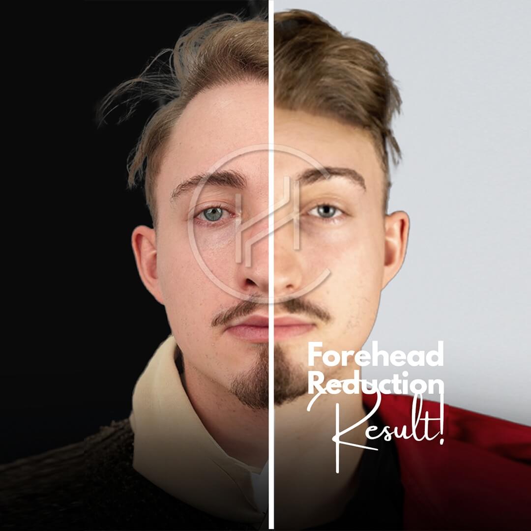 Male Forehead Reduction Before and After