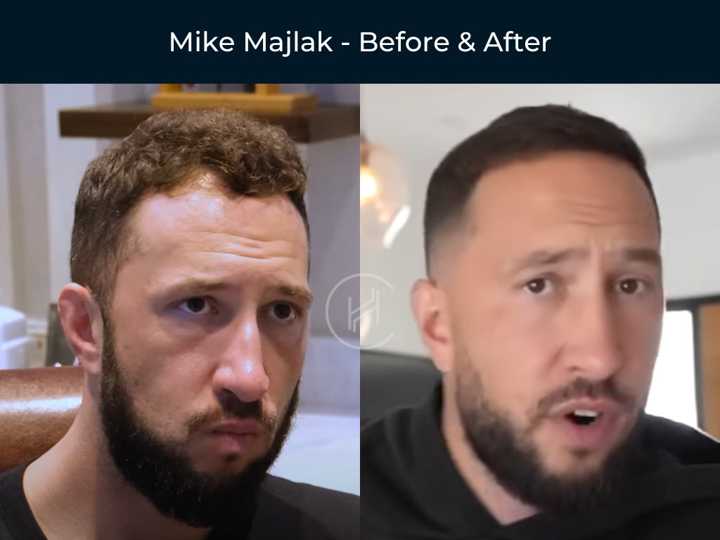 Mike Majlak - Hair Transplant Before and After Mike Majlak - Hair Transplant Before and After