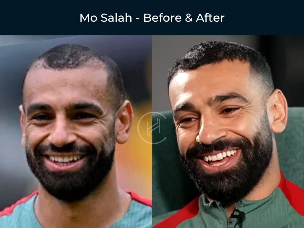 Mo Salah - Hair Transplant Before and After Mo Salah - Hair Transplant Before and After