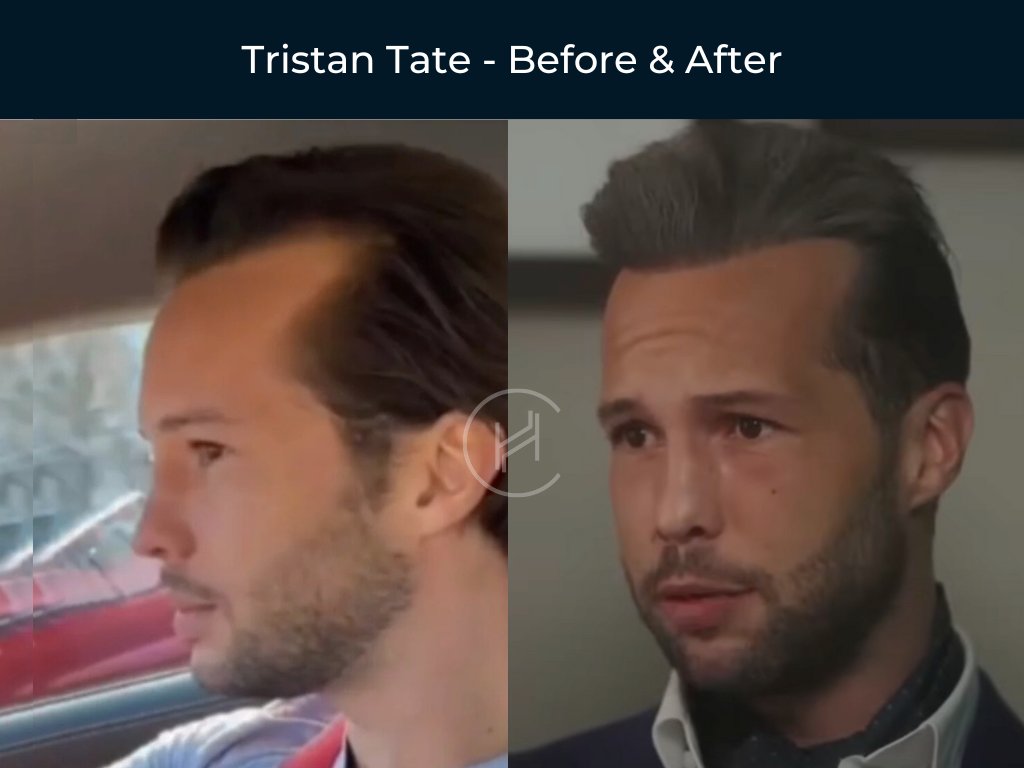 Tristan Tate - Hair Transplant Before and After Tristan Tate - Hair Transplant Before and After