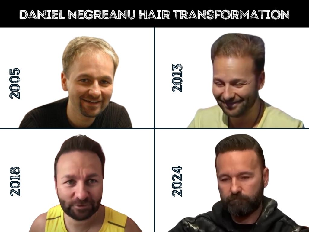 daniel negreanu hair transformation