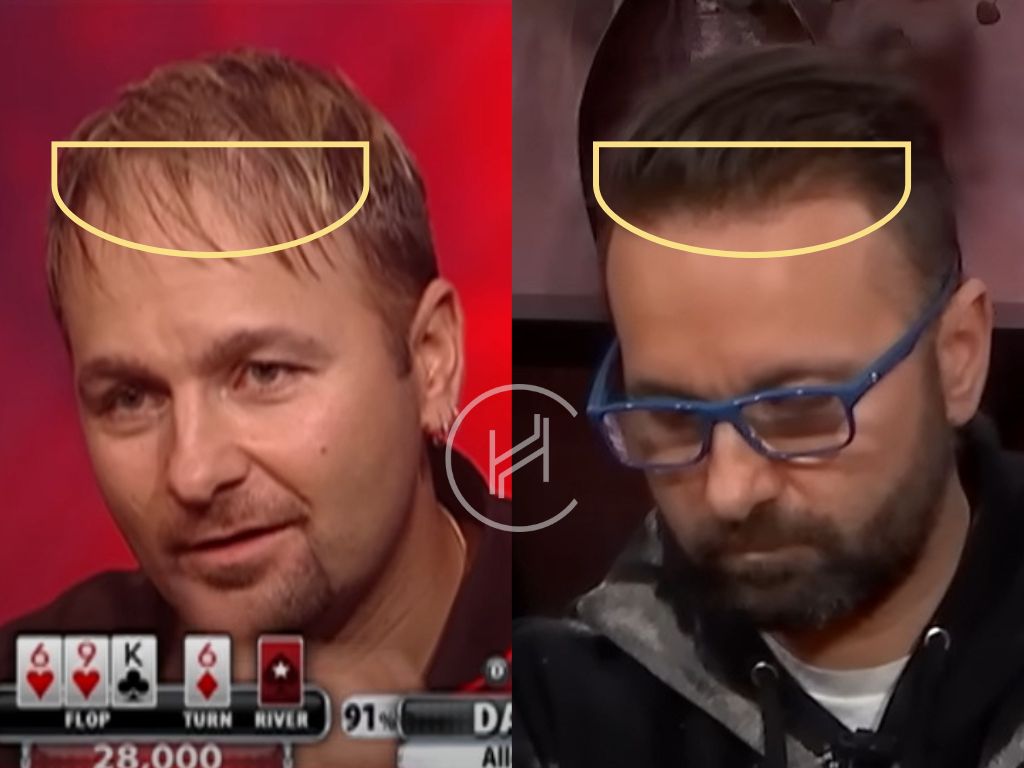 daniel negreanu hair transplant before after result