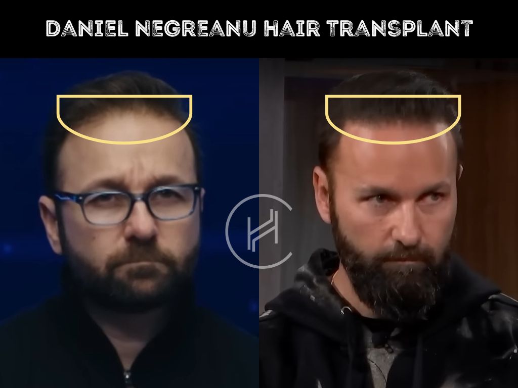 daniel negreanu hair transplant before after