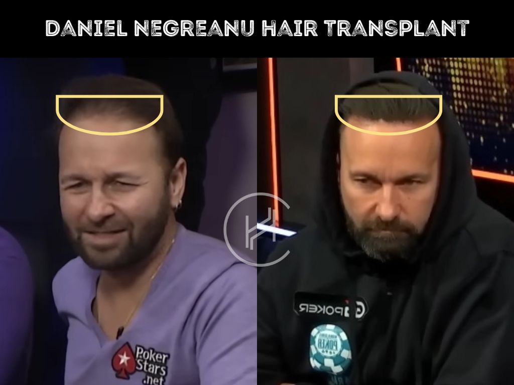 daniel negreanu hair transplant before and after result