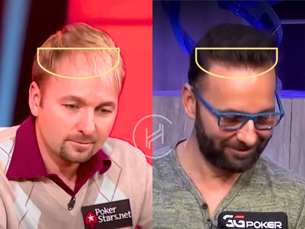 daniel negreanu - hair transplant before and after