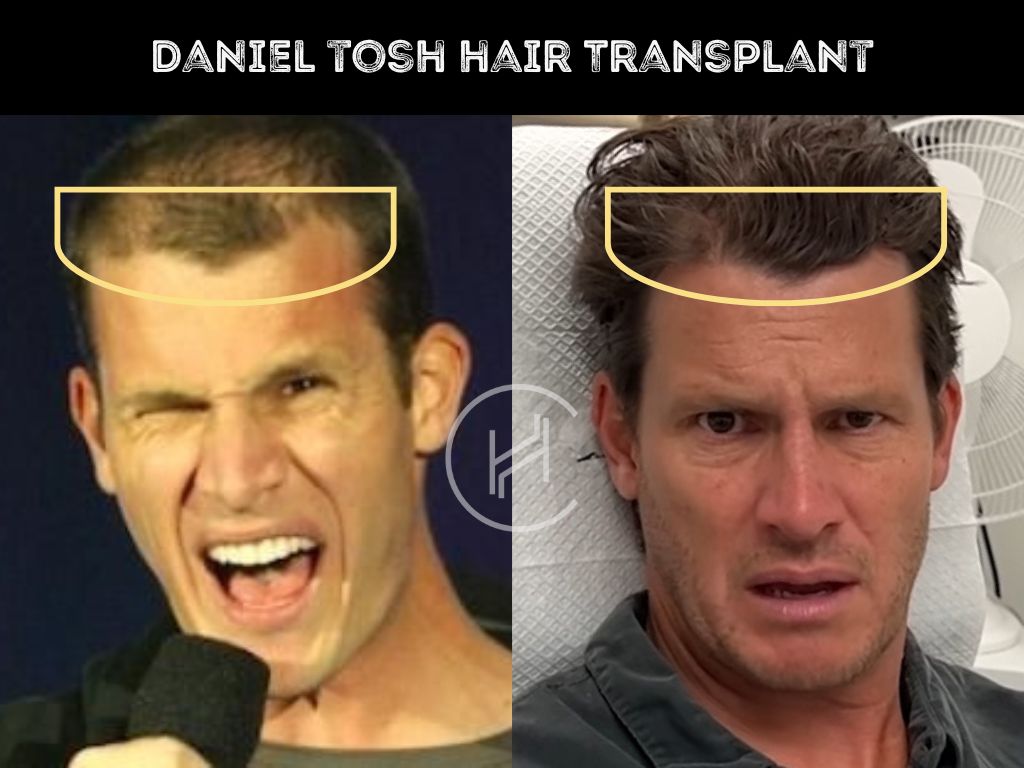 daniel tosh hair transplant before after result