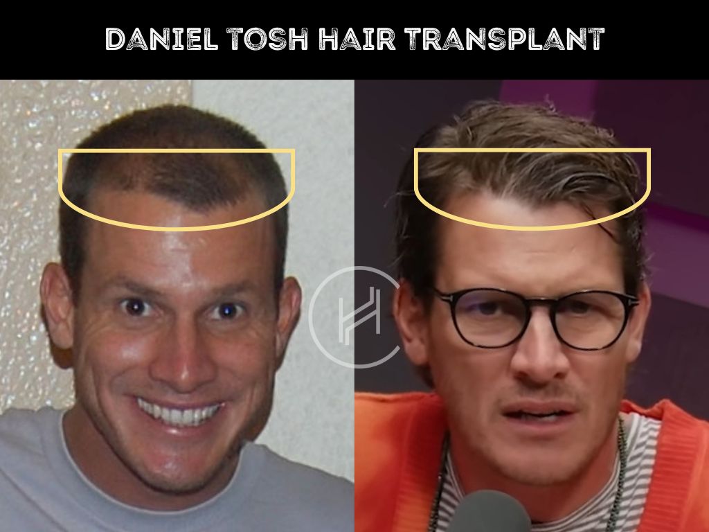 daniel tosh hair transplant before and after