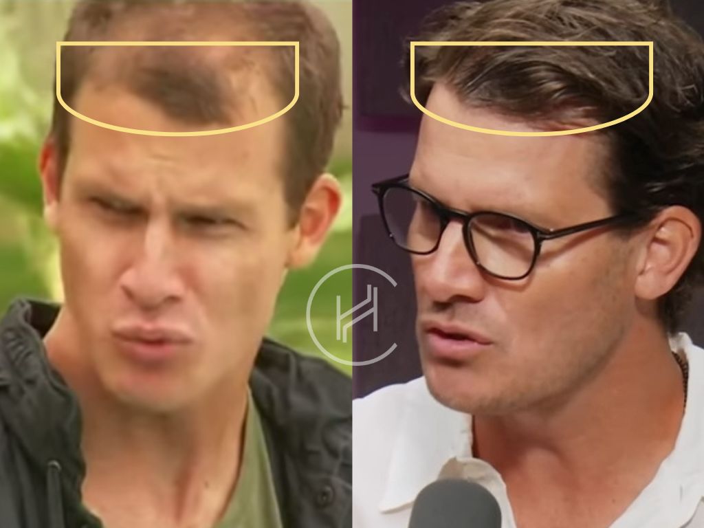 daniel tosh hair transplant before and after result