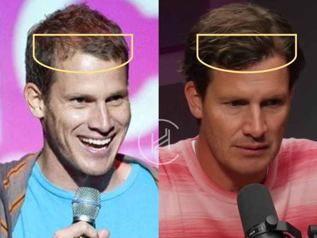 daniel tosh hair transplant before and after