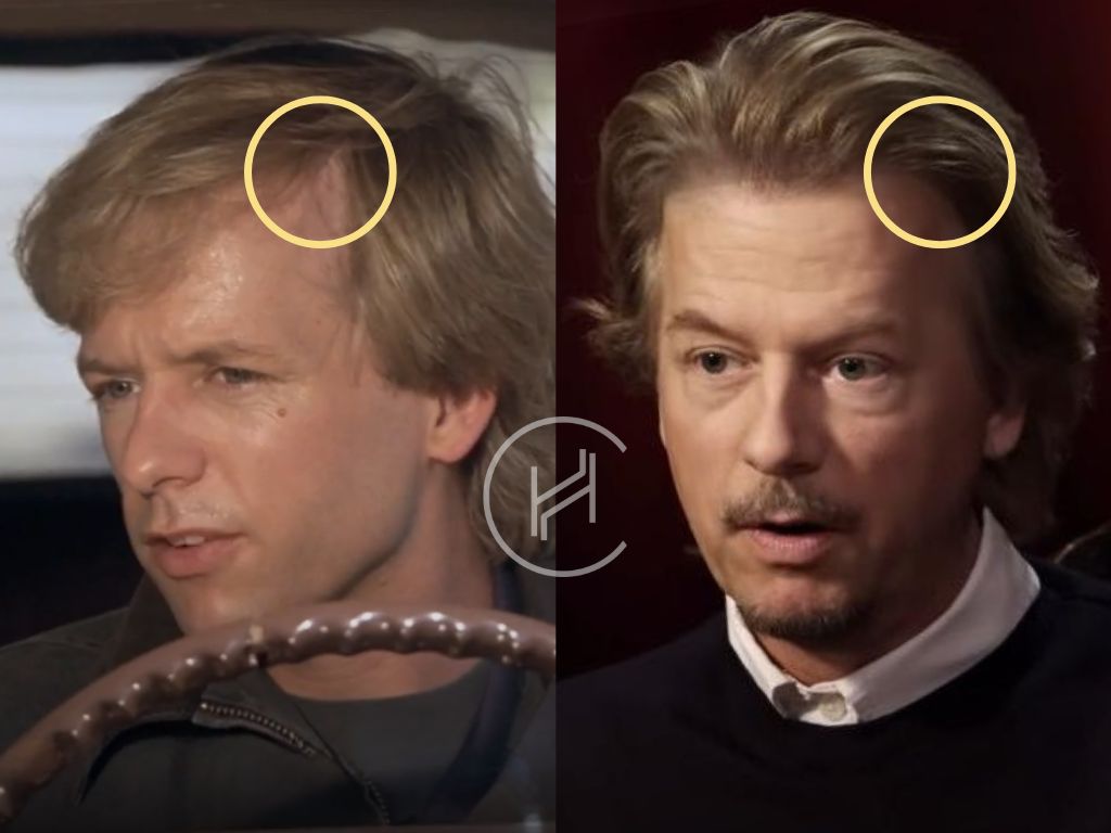 david spade hair transplant before after