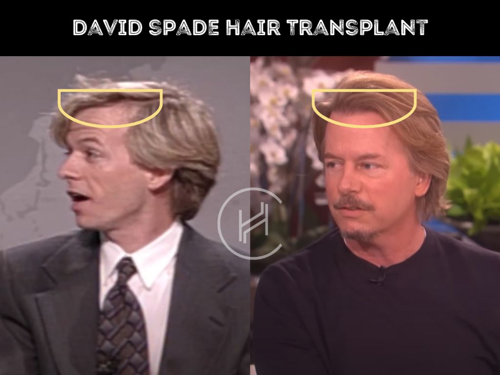 david spade hair transplant before and after result