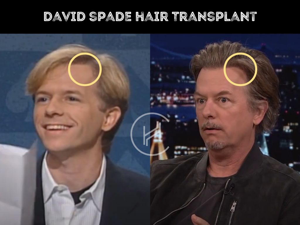 david spade hair transplant before and after