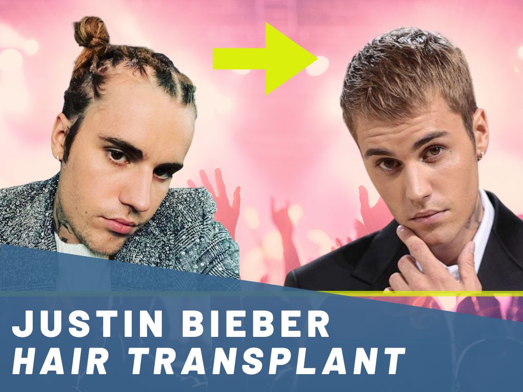 justin bieber hair transplant analysis banner