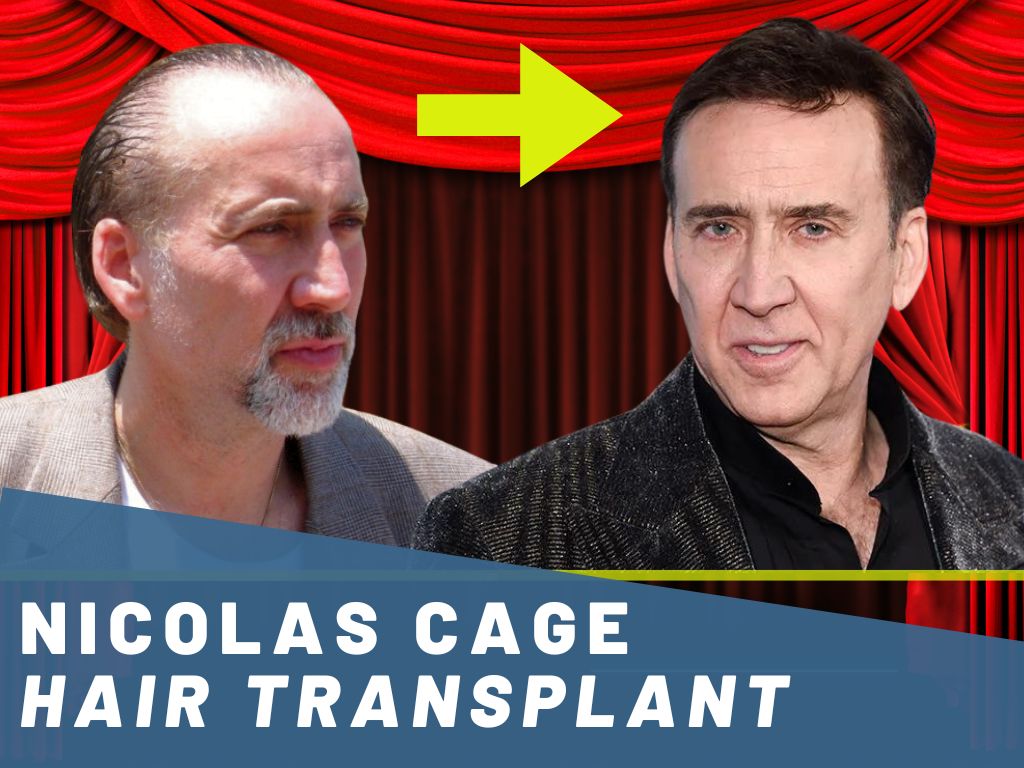 nicolas cage hair transplant analysis banner