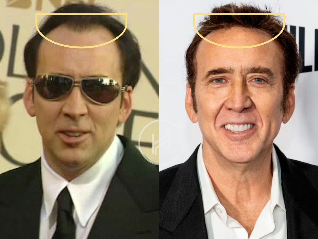 nicolas cage hair transplant before after result