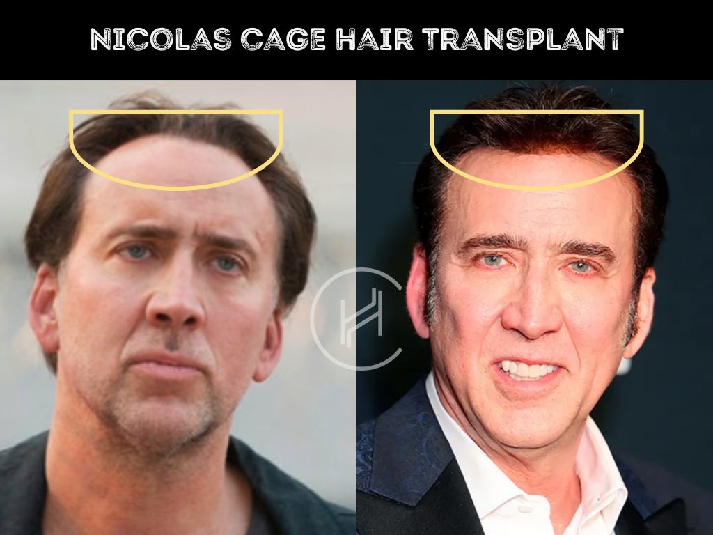 nicolas cage hair transplant before & after
