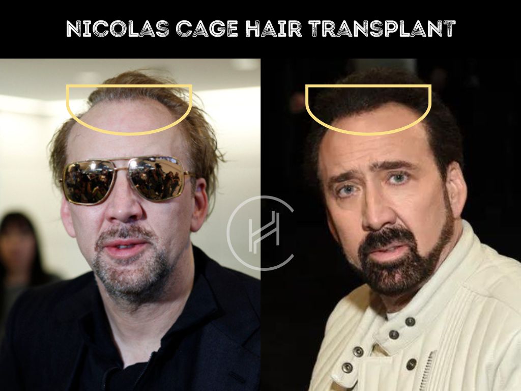 nicolas cage hair transplant before and after result