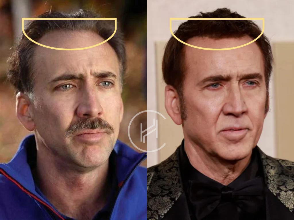 nicolas cage hair transplant before and after