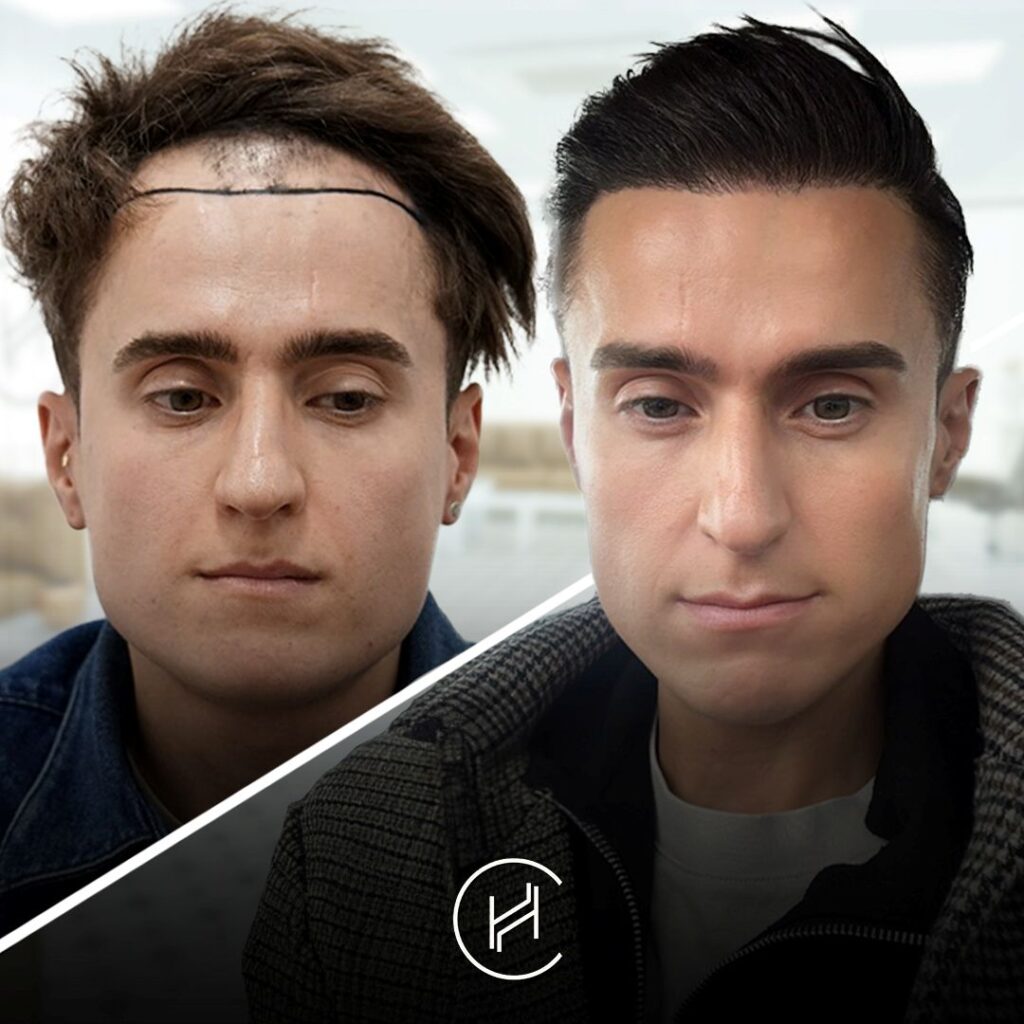 3000 grafts hair transplant result in turkey