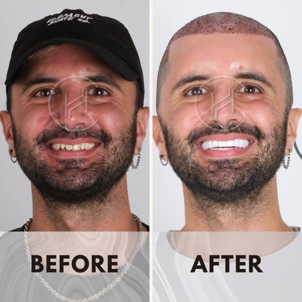 Hevadent smile makeover dental procedure before and after