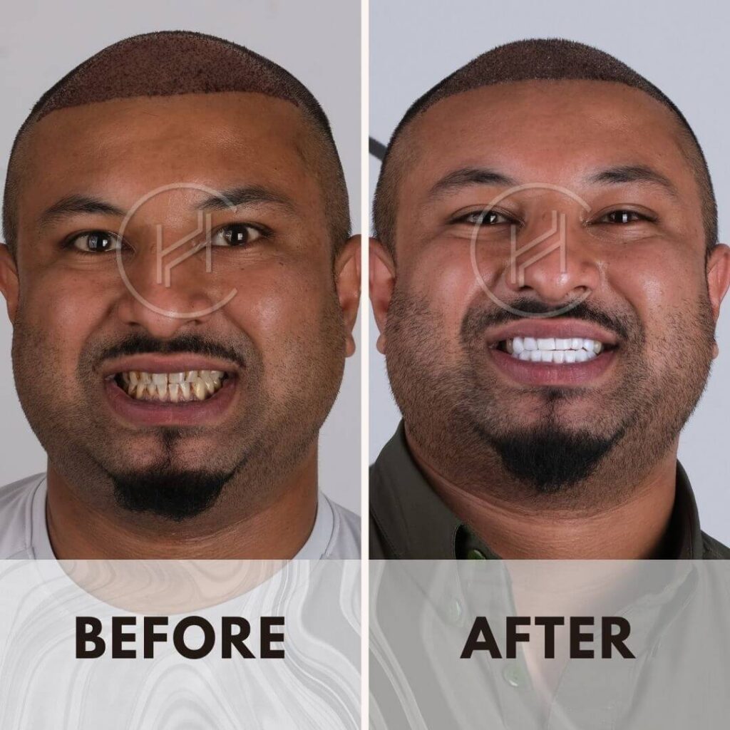 Male smile makeover procedure before and after turkey istanbul