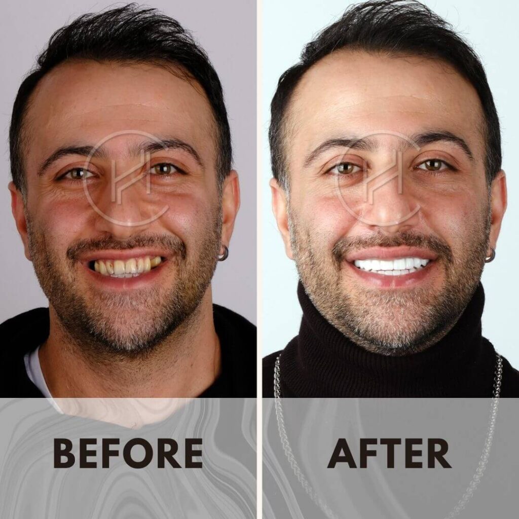 Male smile makeover result in Turkey at Hevadent
