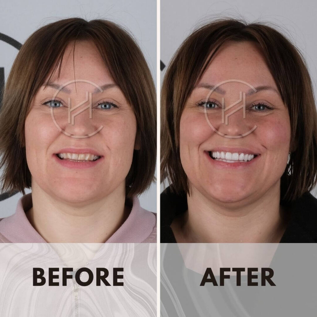 Smile makeover at hevadent istanbul turkey