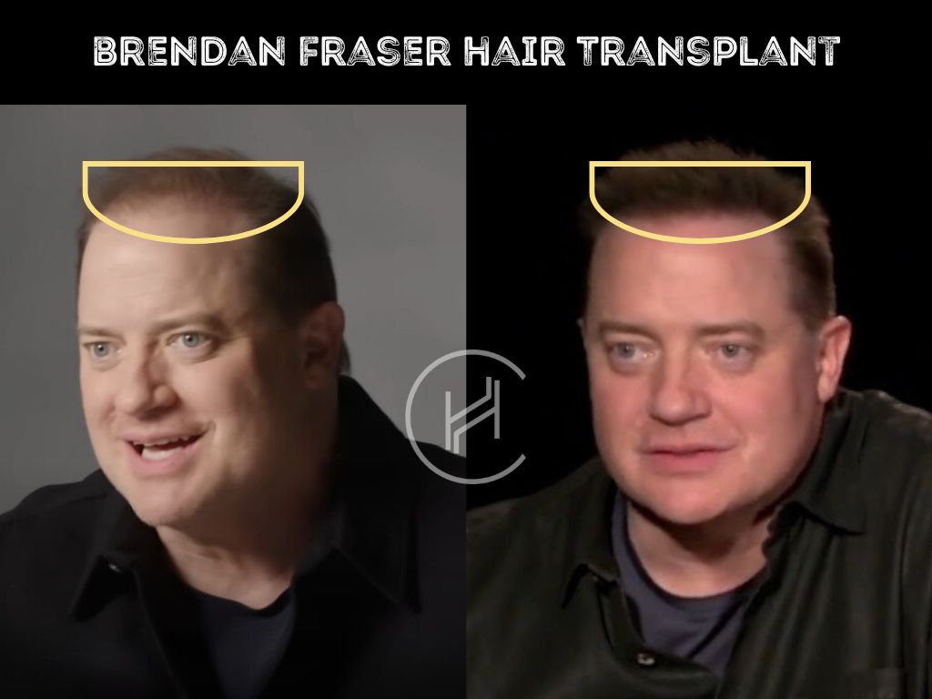 brendan-fraser-hair-transplant-before-after-result brendan fraser hair transplant before after result