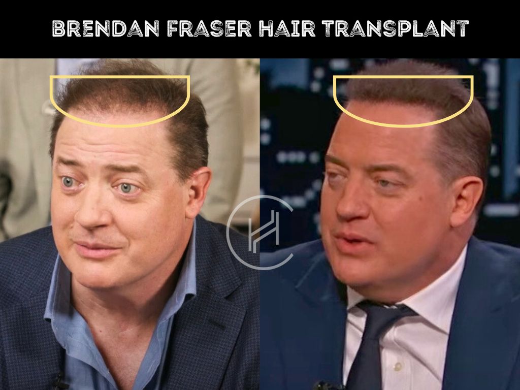 brendan fraser hair transplant before after