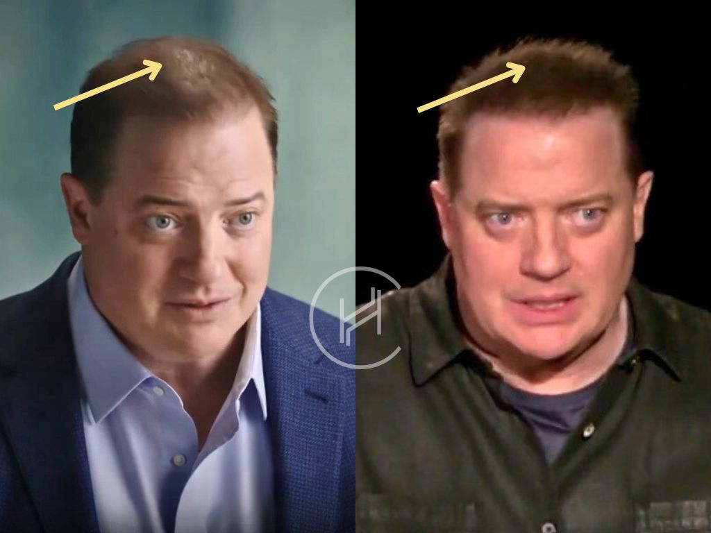 brendan fraser hair transplant before and after result
