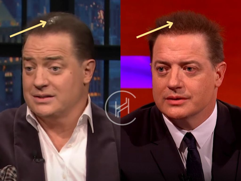 brendan fraser - hair transplant before and after