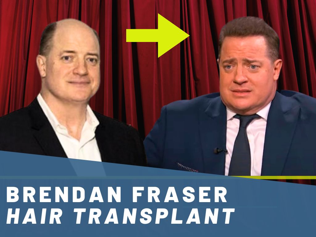 brendan fraser hair transplant analysis banner