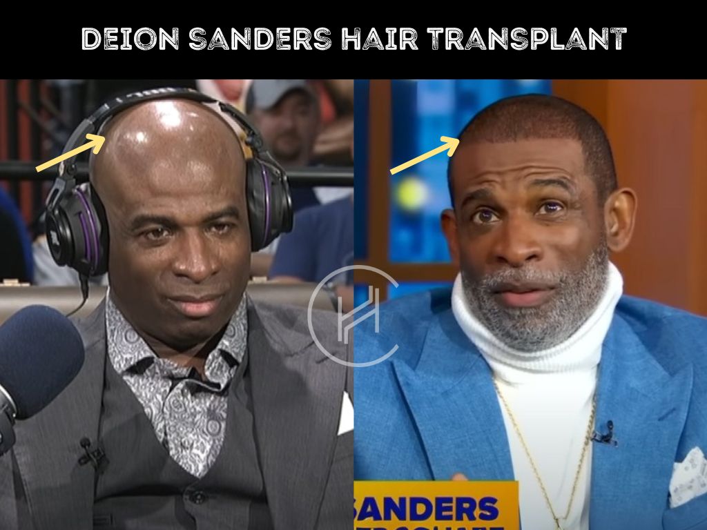 deion sanders hair transplant before after result