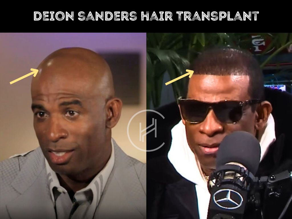 deion sanders hair transplant before after