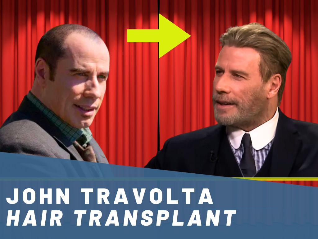 john travolta hair transplant analysis banner