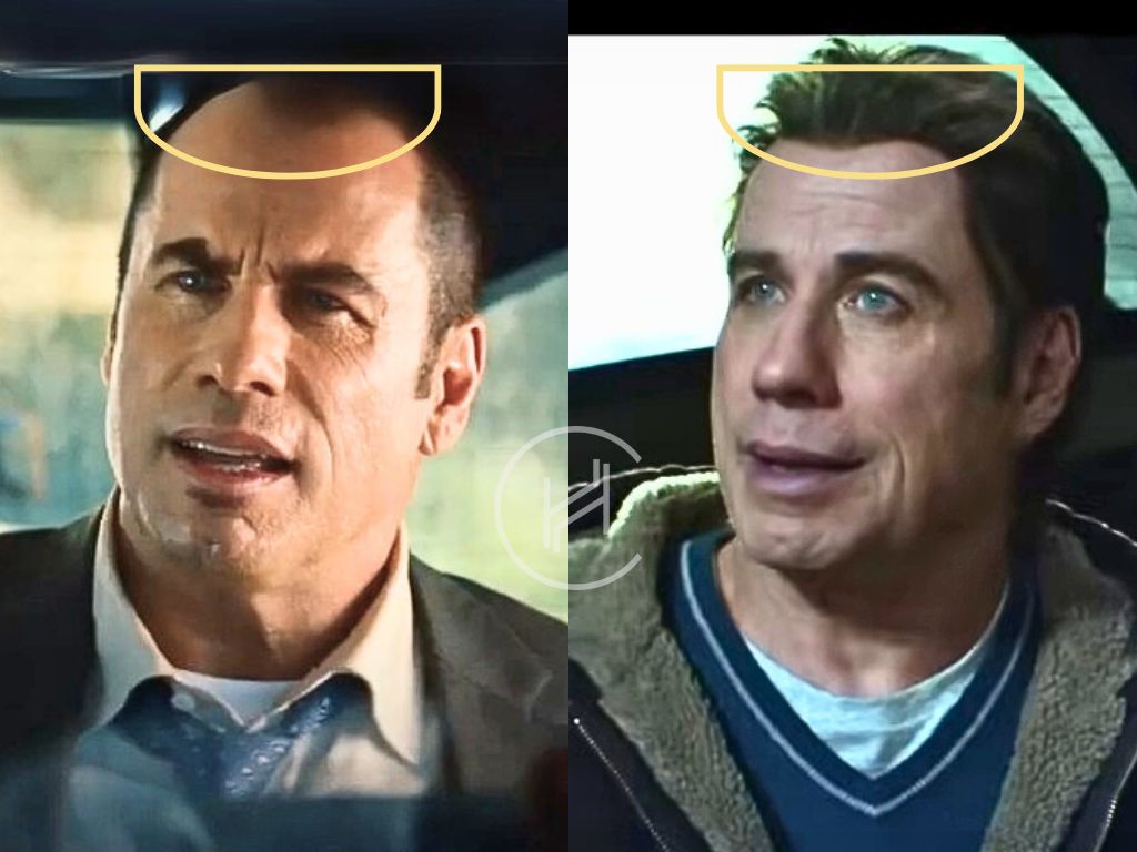 john-travolta-hair-transplant-before-after-result