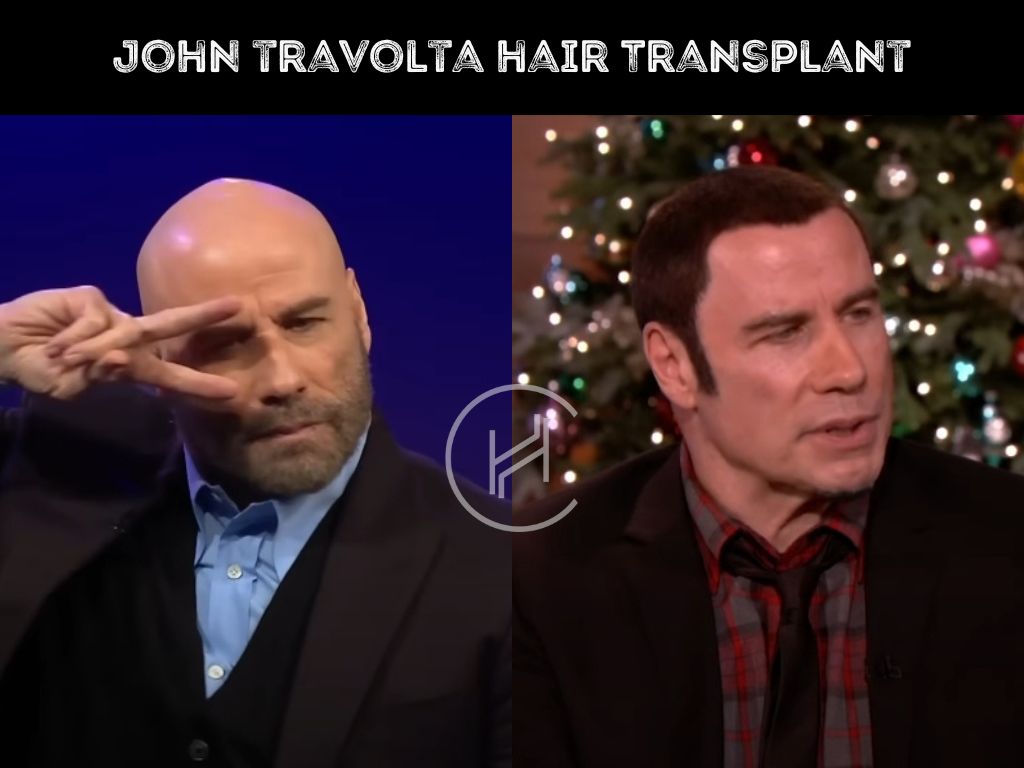john travolta hair transplant before and after result