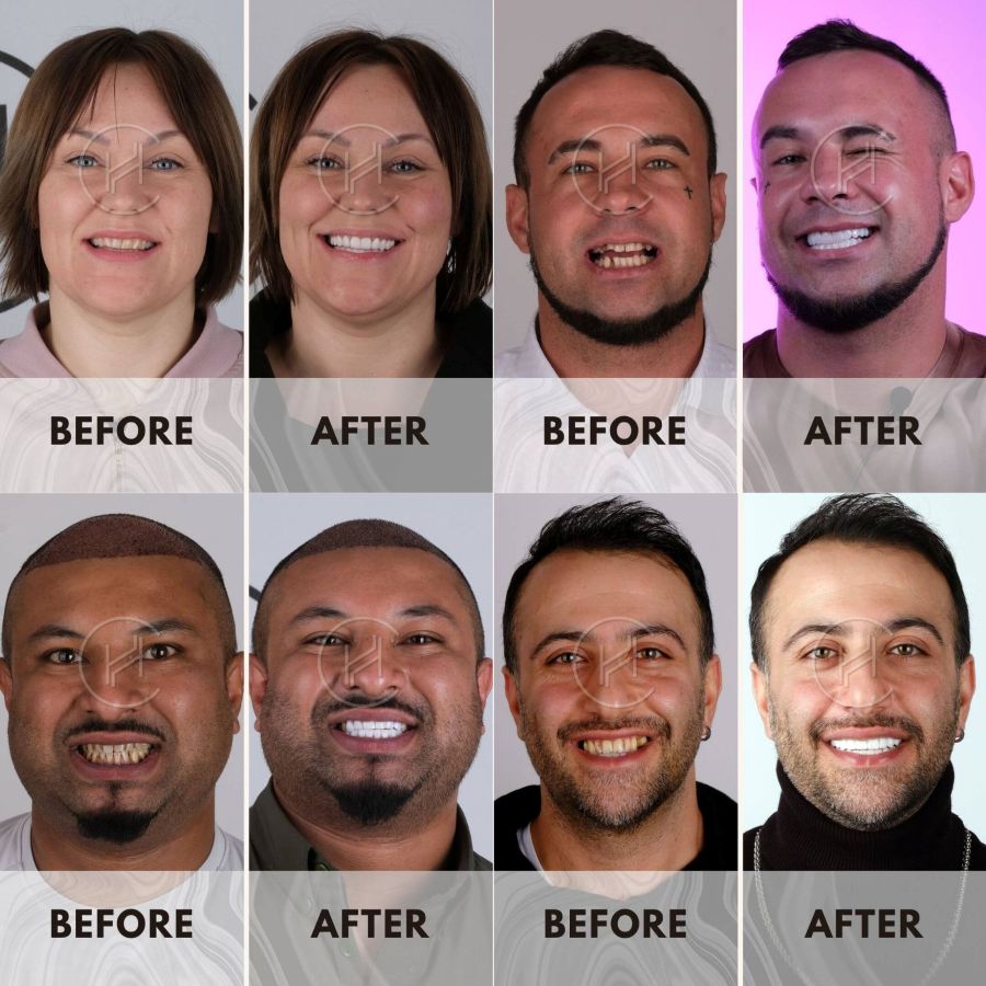 smile makeover 4 before and after results at hevadent istanbul turkey