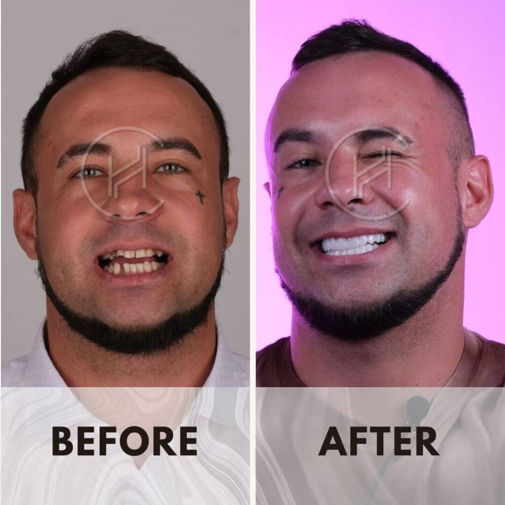 smile makeover in Turkey before and after result