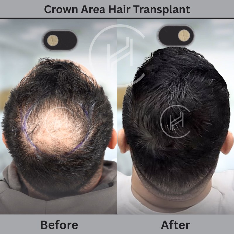 Crown (Vertex) Area Hair Transplant Result Before and After Heva Clinic Turkey