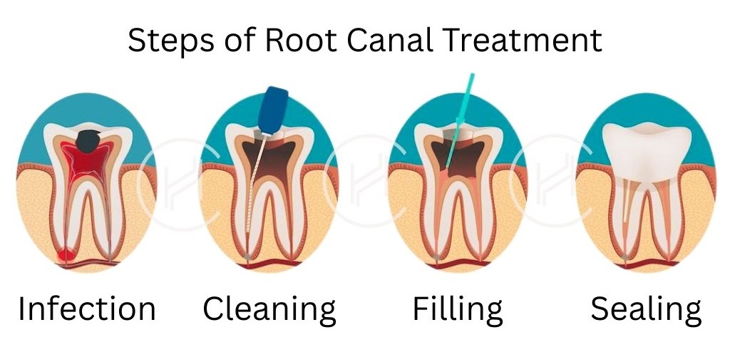 Steps of Root Canal Treatment
