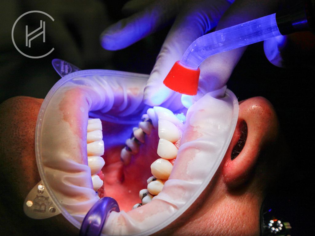 Teeth filling process in Turkey