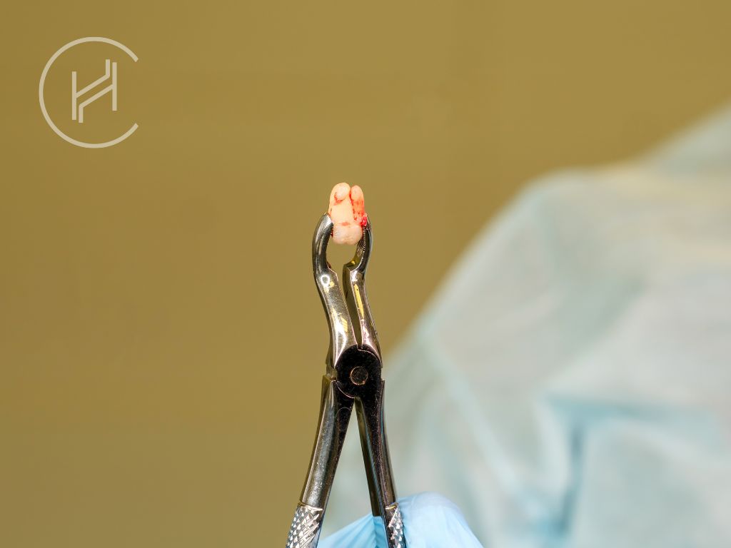 When Can I Smoking After a Tooth Extraction