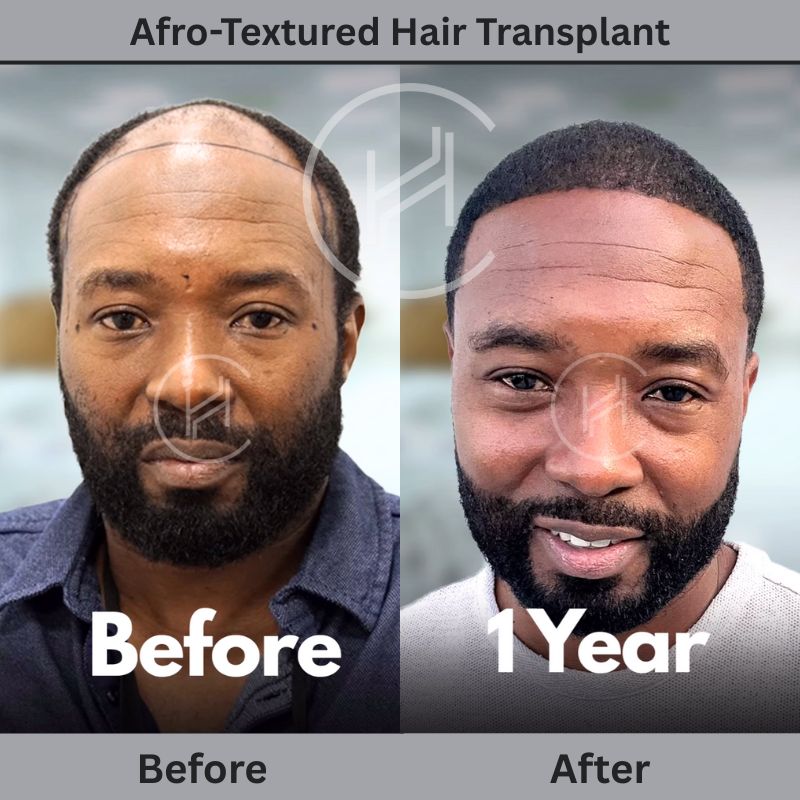 afro textured fue hair transplant in Turkey before and after result afro textured fue hair transplant in Turkey before and after result