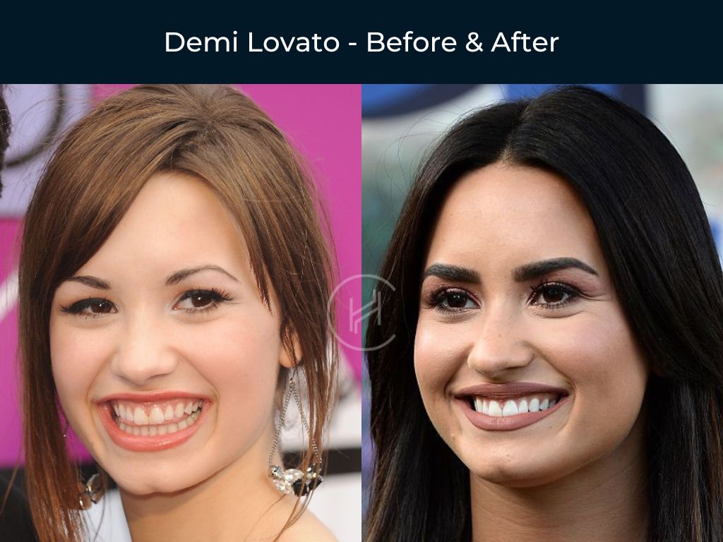 demi-lovato-dental-before-after