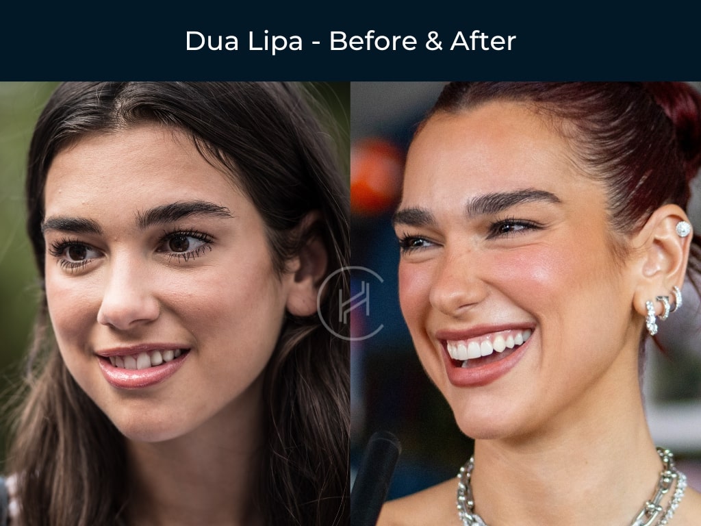 dua-lipa-dental-veneers-before-after-result dua lipa dental veneers before after result