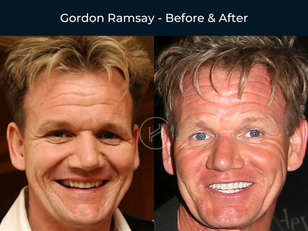 gordon-ramsay-dental-before-after